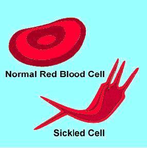 Gráfico de glóbulo normal VS glóbulo falciforme